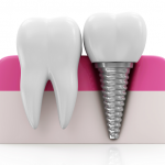 Explaining the Different Types of Dental Implants